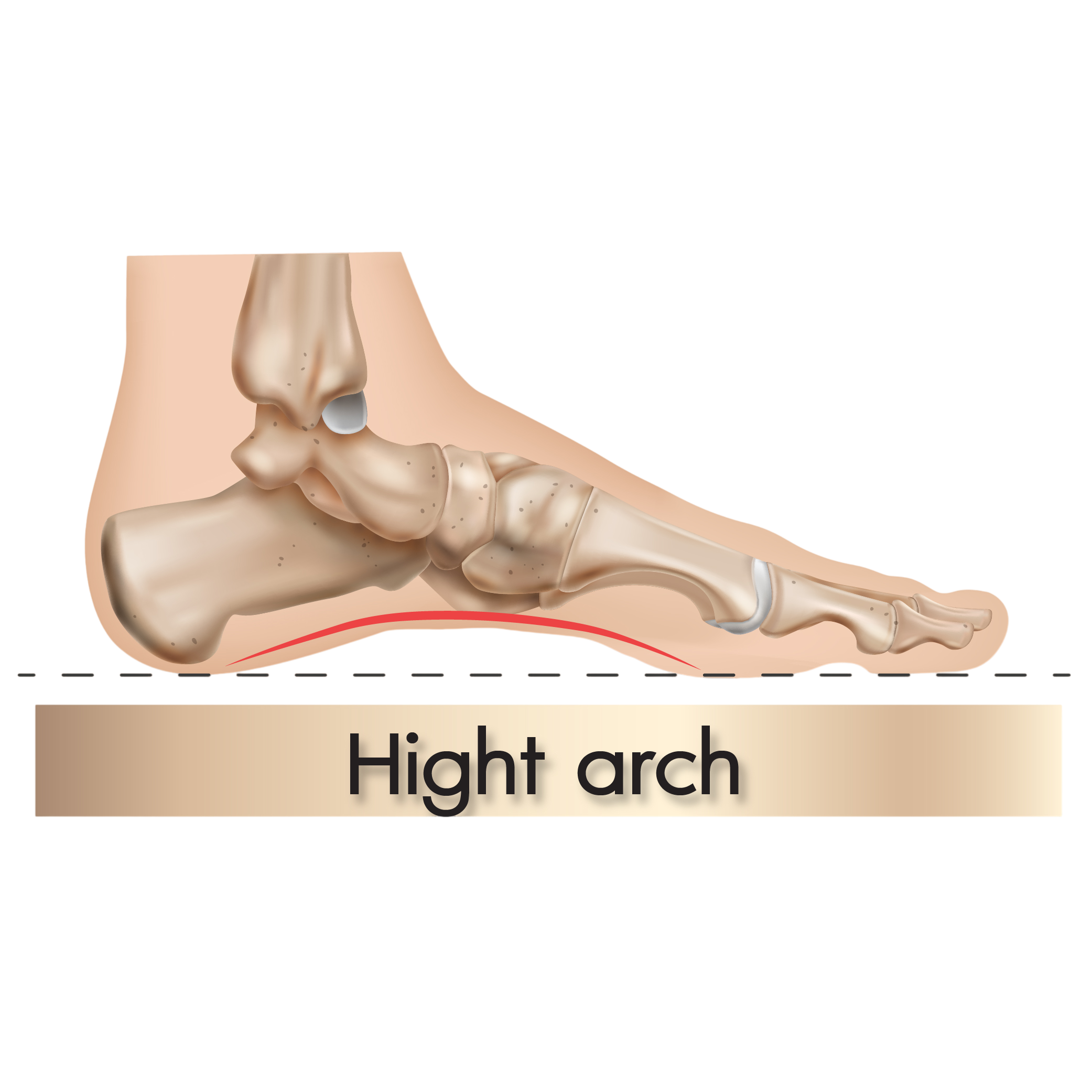 High Arch