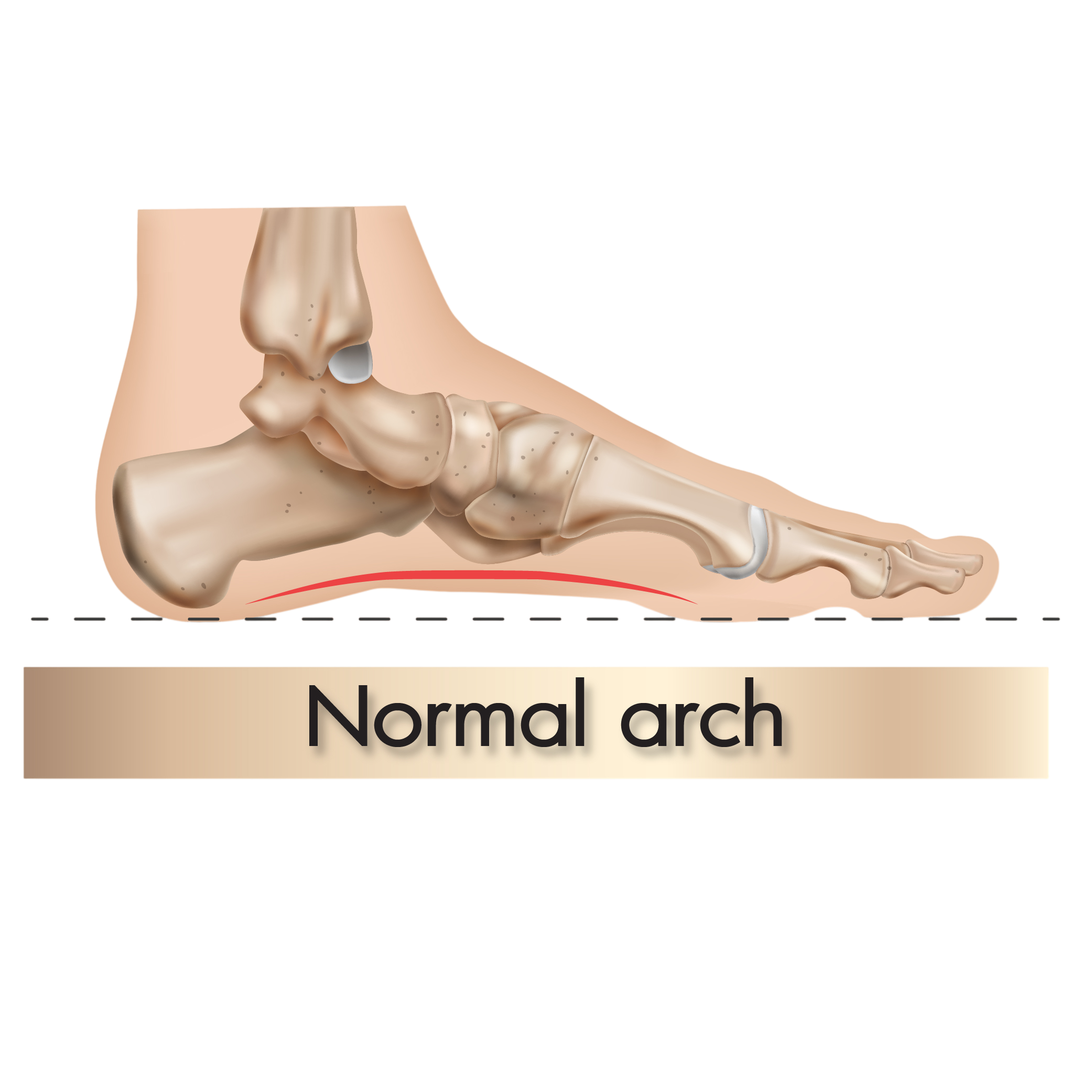 Normal Arch