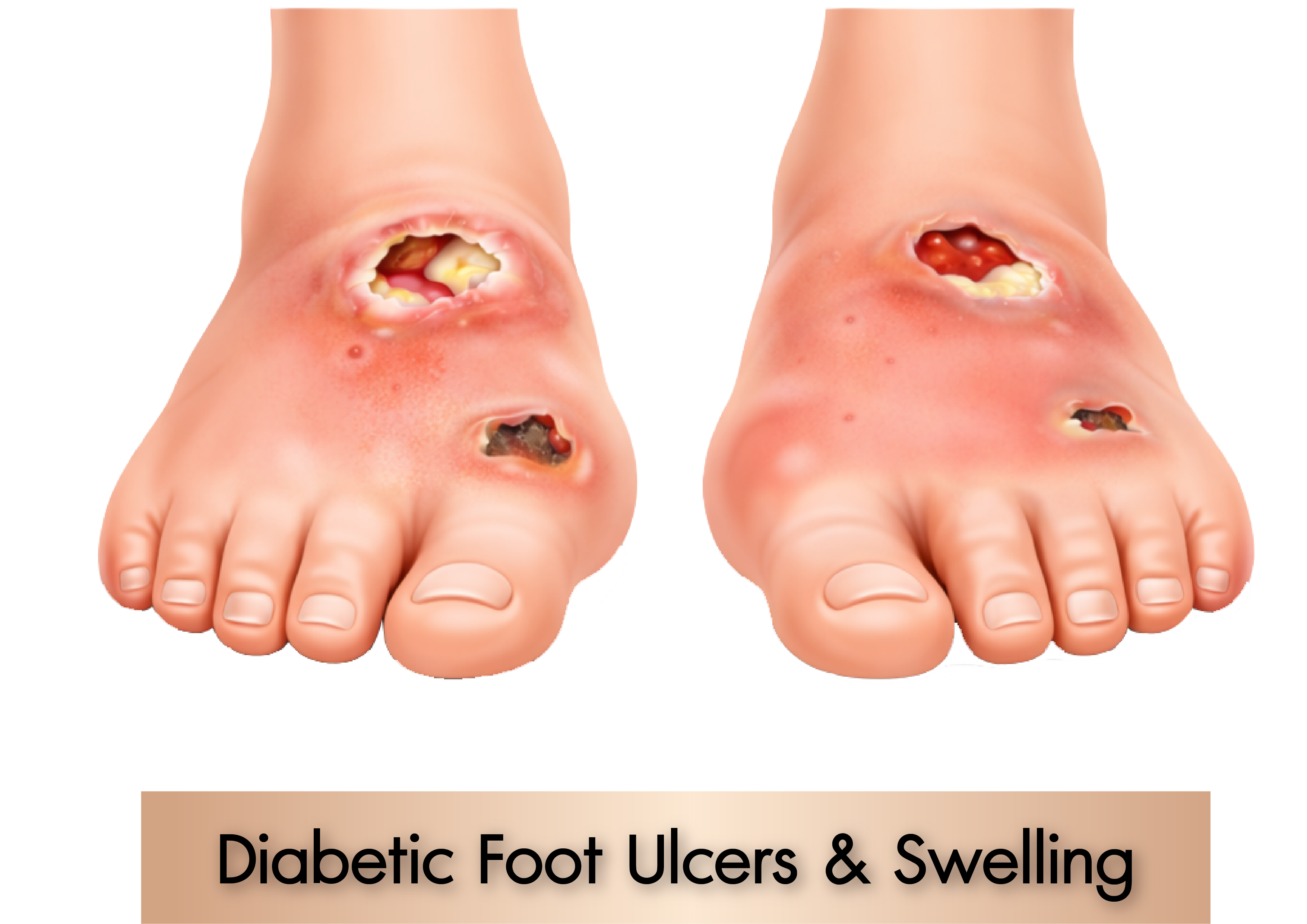 Diabetic Foot
