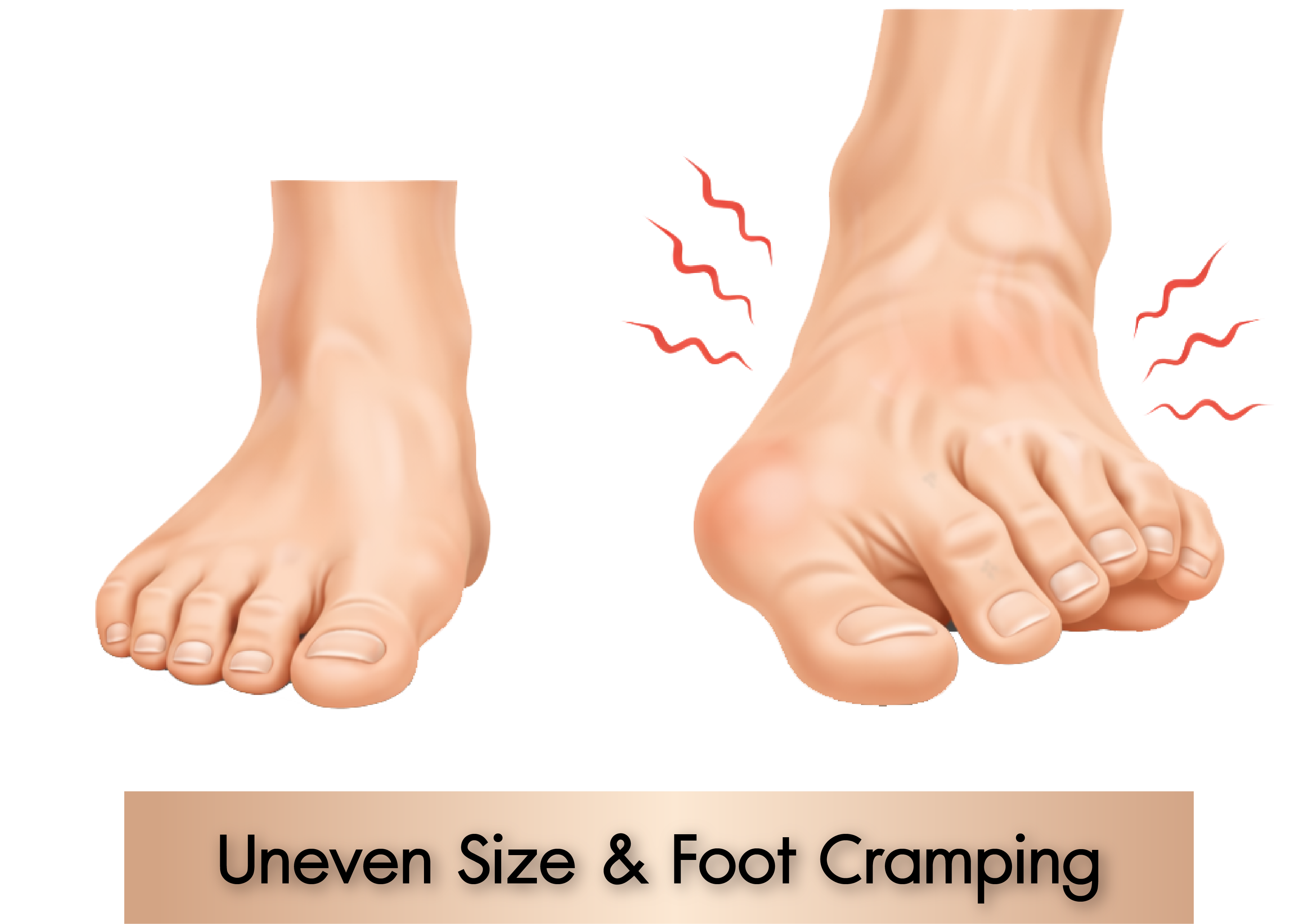 Foot Deformity