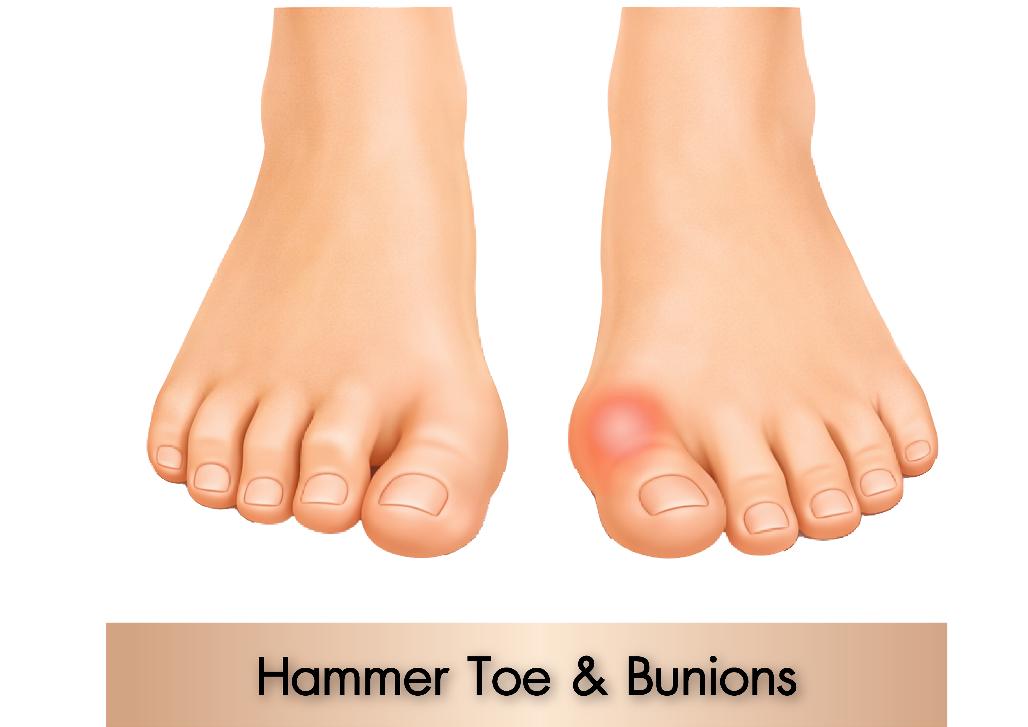 Hammertoe & Bunion